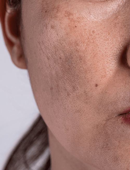melasma